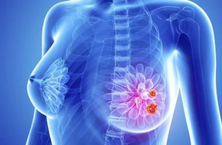 Un nuevo fármaco frena un cáncer de mama muy agresivo en el 75% de las pacientes